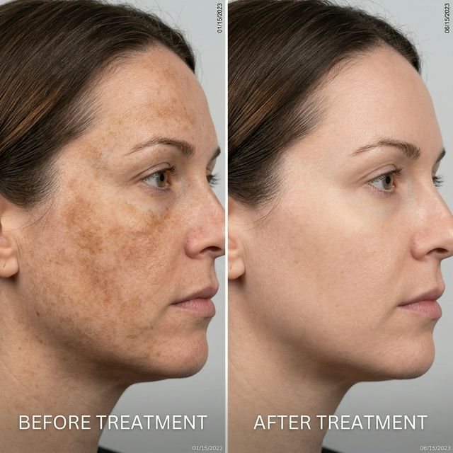 Pigmentation Result