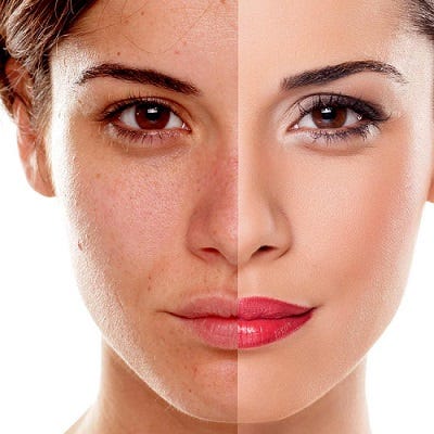 Pigmentation treatment 