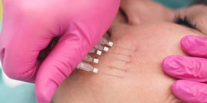 PLLA/ PCL Biostimulators