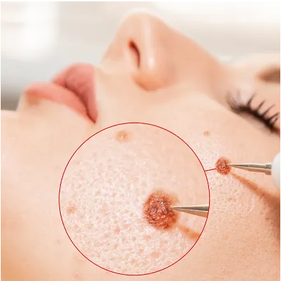 Mole removal with laser