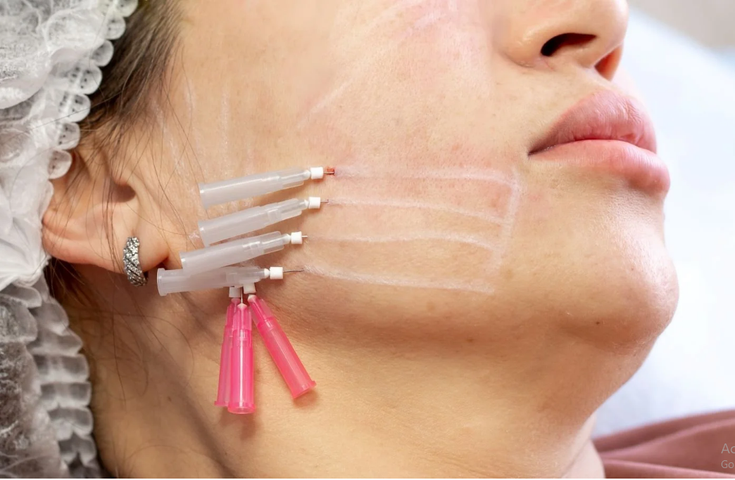 Thread Lift