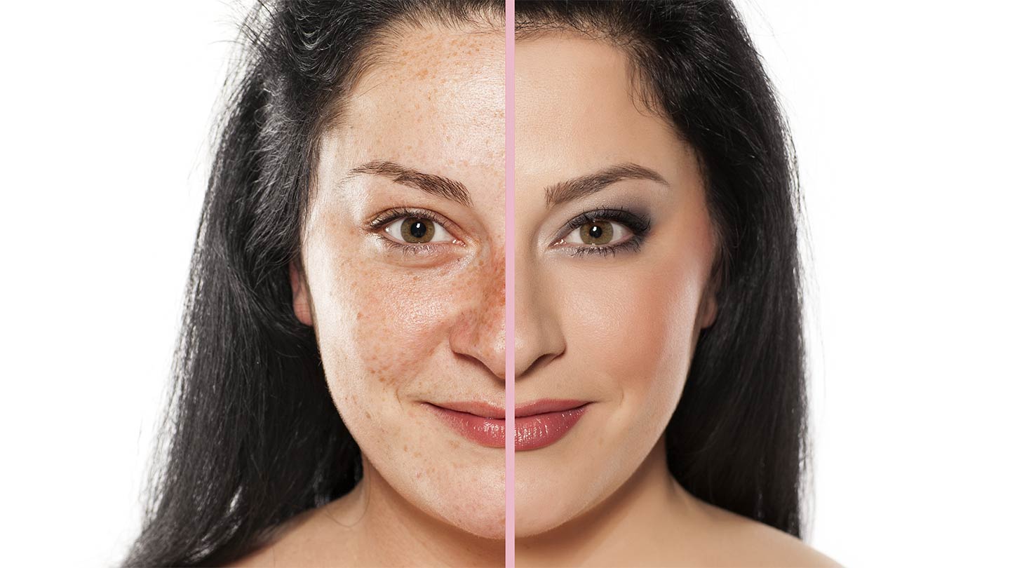 Freckles treatment with laser
